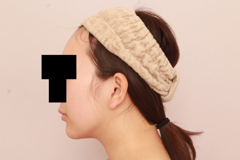 ほほ顎脂肪吸引でまっすます美人さんに♡