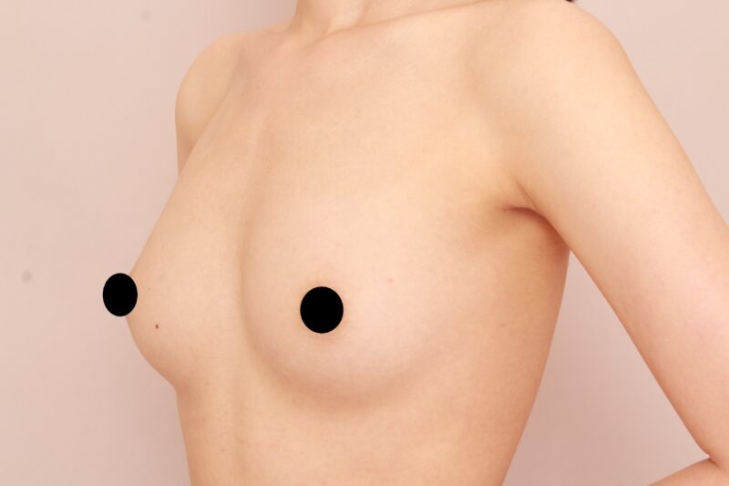 親子でコンデンスリッチ豊胸♡お嬢様のバストの変化半年後♪