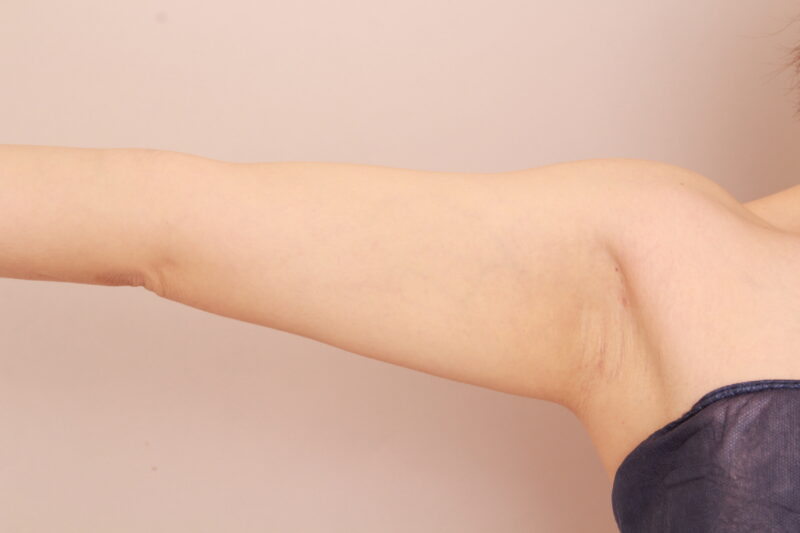 二の腕・肩の脂肪吸引 術後3カ月の経過