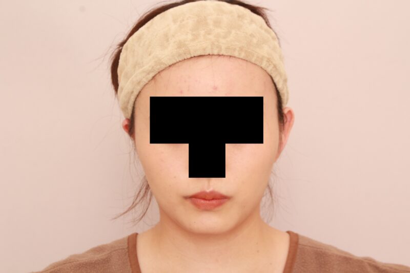 まっすます美人さんに♡ほほ顎脂肪吸引3か月後