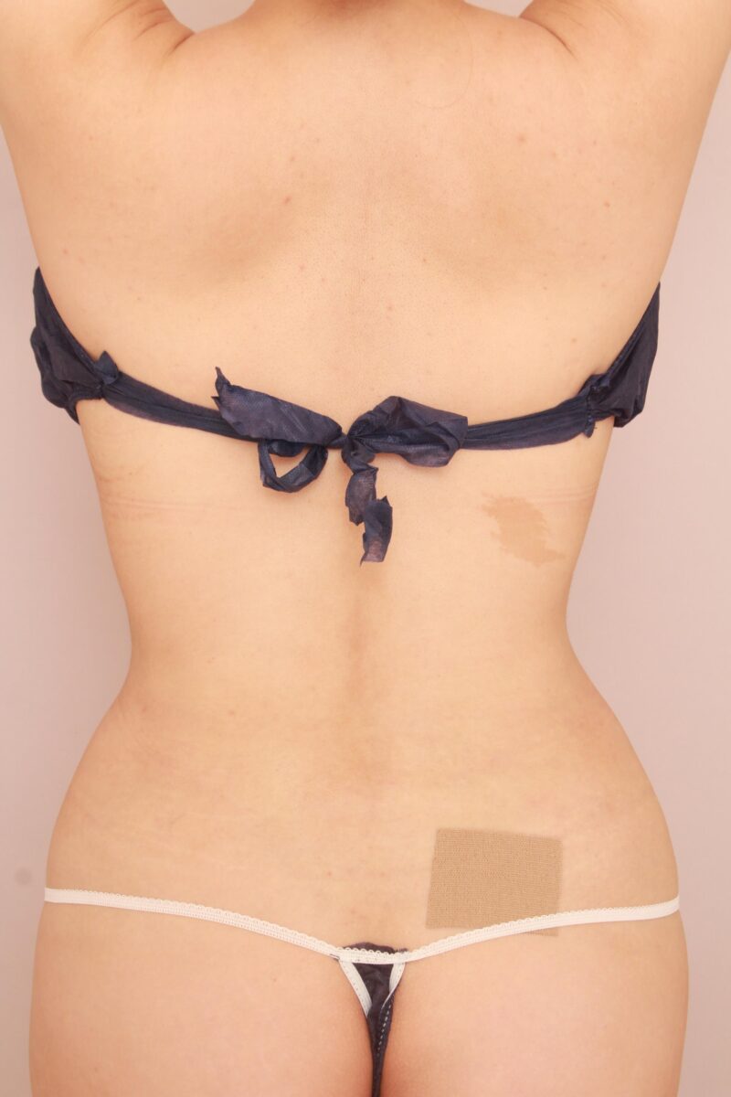 みんなで目指そう峰不二子♡お腹全体胸下腰の脂肪吸引の3か月後