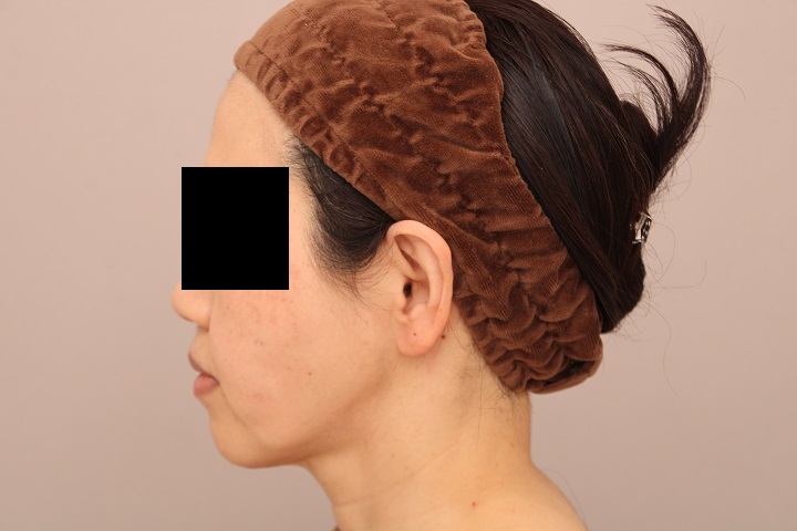 お顔の脂肪吸引 術後3カ月の経過