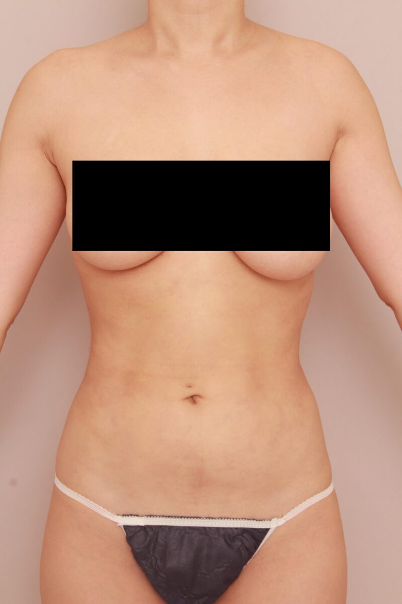 みんなで目指そう峰不二子♡お腹全体胸下腰の脂肪吸引1か月後