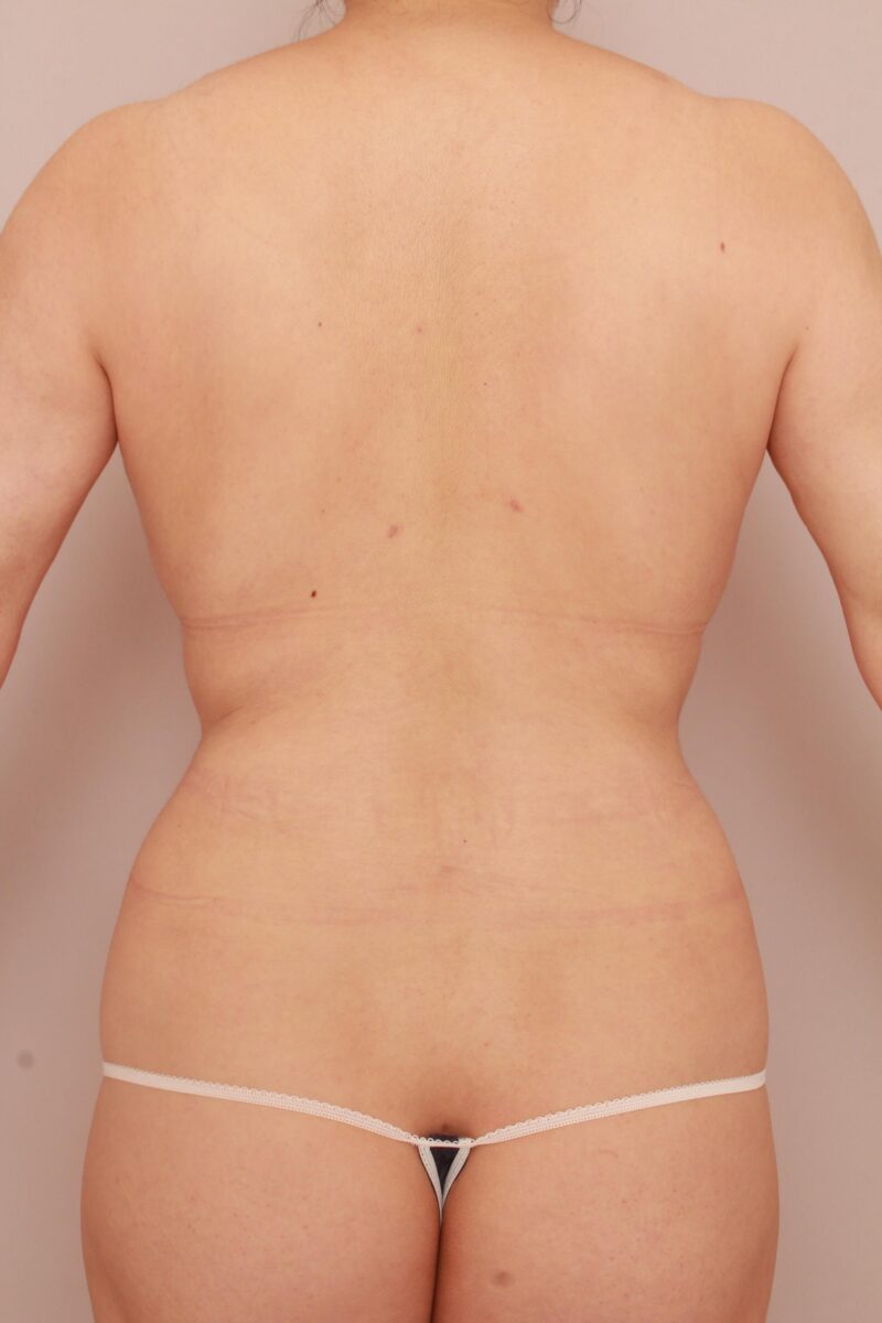 みんなで目指そう峰不二子♡お腹全体胸下腰のモニター様半年後♡