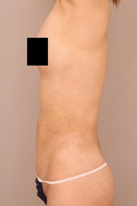 お腹と腰の脂肪吸引　術後1ヵ月の経過