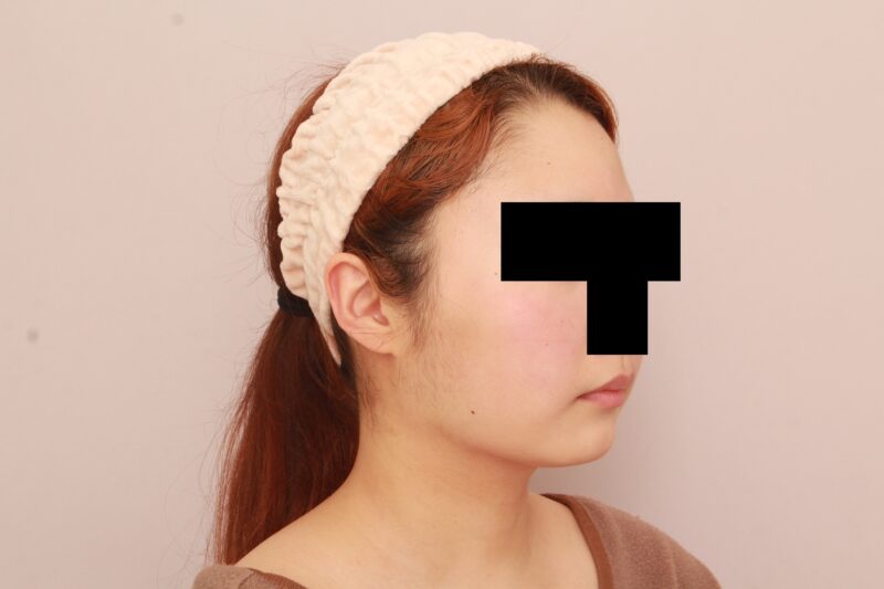 ほほ顎脂肪吸引でまっすます美人さんに♡3か月後