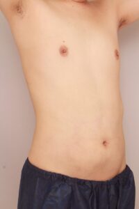 腹部、腰の脂肪吸引の術後１ヶ月