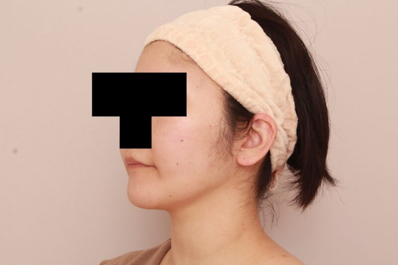 ほほ顎脂肪吸引3か月後♡ナチュラルにまっすます美人さんに♡