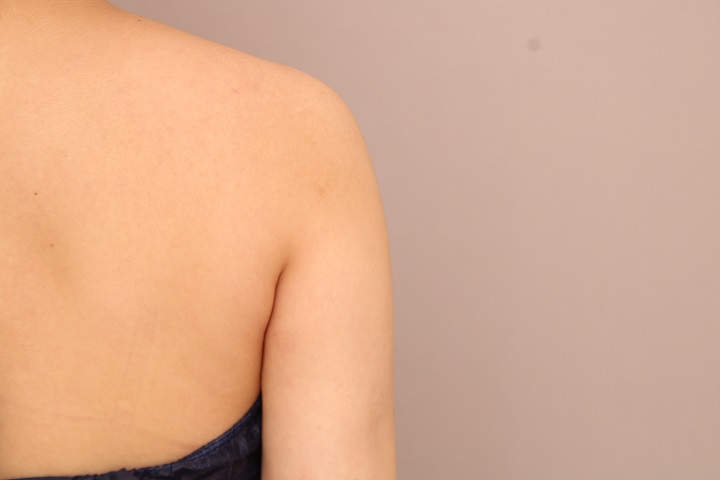 二の腕・肩の脂肪吸引 術後6ヵ月の経過