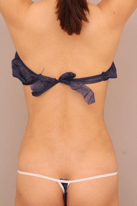 腰の脂肪吸引 術後4か月の経過