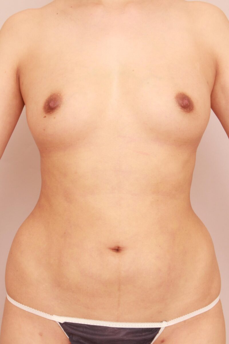 みんなで目指そう峰不二子♡お腹全体胸下腰の脂肪吸引からのコンデンスリッチ豊胸♪