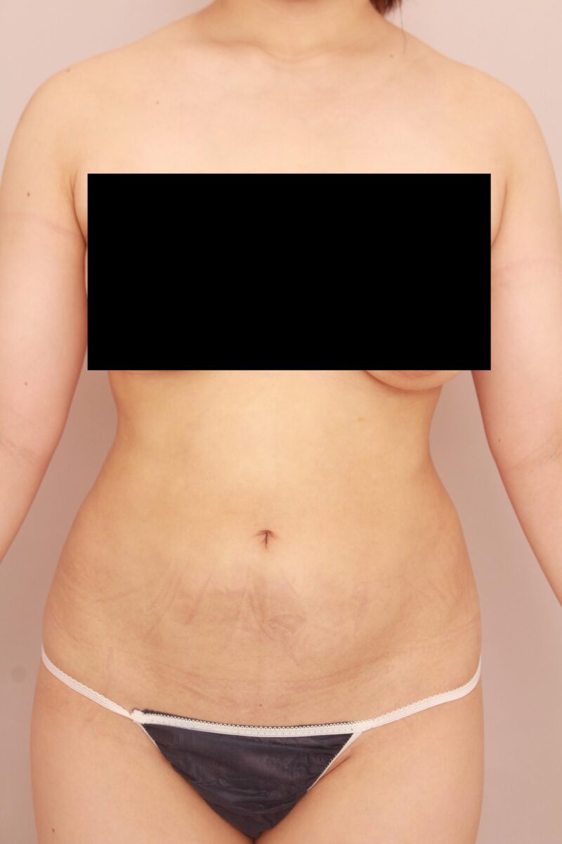 みんなで目指そう峰不二子♡お腹全体胸下腰の脂肪吸引3か月後