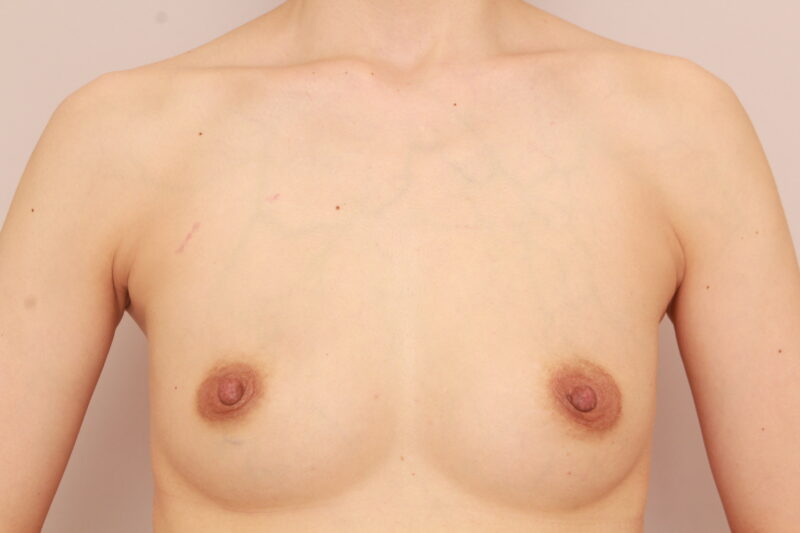 授乳後のバストの若返り!!コンデンスリッチ豊胸♡