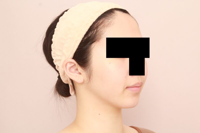 ほほ顎脂肪吸引3か月後♡