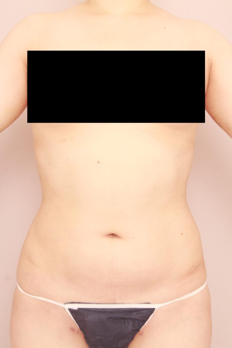 みんなで目指そう峰不二子♡お腹全体胸下腰の脂肪吸引3か月後