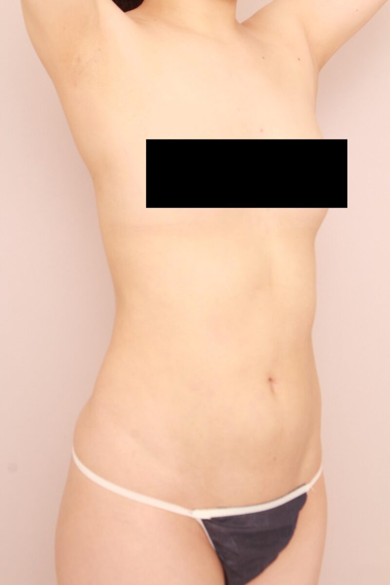 お腹・腰の脂肪吸引　術後3カ月の経過