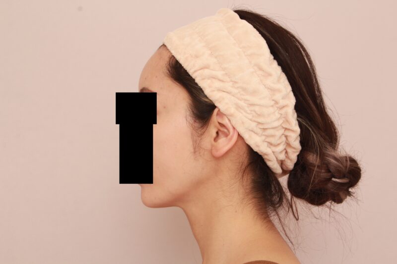 オデコこめかみの脂肪注入で輪郭からエイジングケア