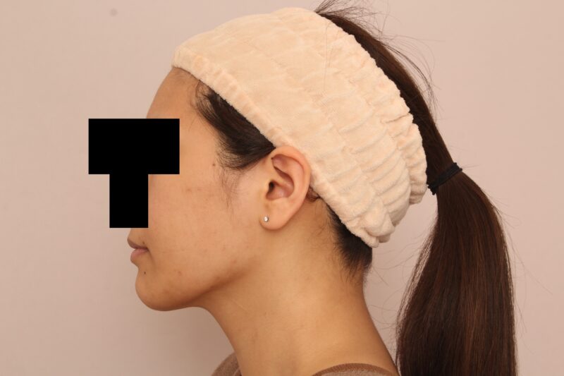 ほほ顎脂肪吸引でますます美人さんに♡