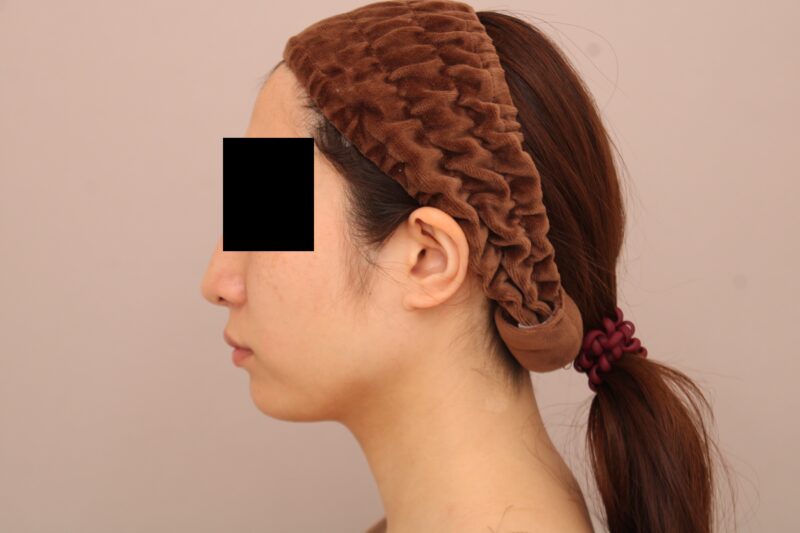 お顔の脂肪吸引 術後3ヵ月の経過