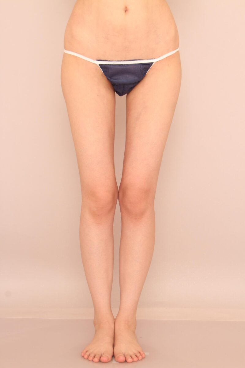 細い方をもっと細く♪太もも全周お尻の脂肪吸引半年後