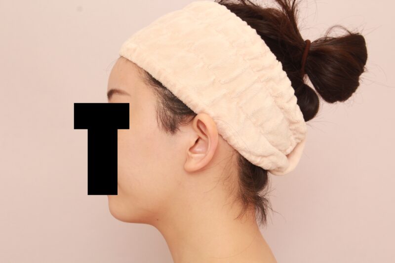 オデコこめかみの脂肪注入による輪郭の変化♡