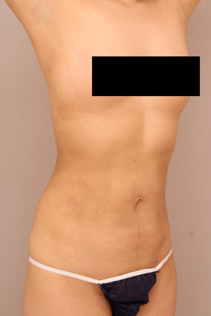お腹・腰の脂肪吸引 術後3ヵ月の経過