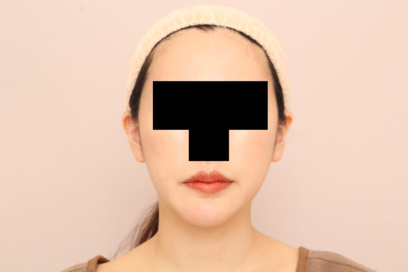 ほほ顎脂肪吸引であなたのキレイに磨きをかけましょう!