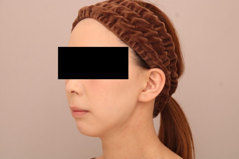 お顔の脂肪吸引 術後1ヵ月の経過