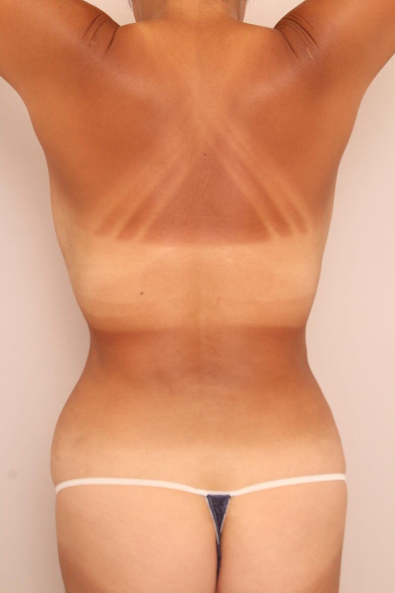 みんなで目指そう峰不二子♡お腹全体胸下腰の脂肪吸引3か月後