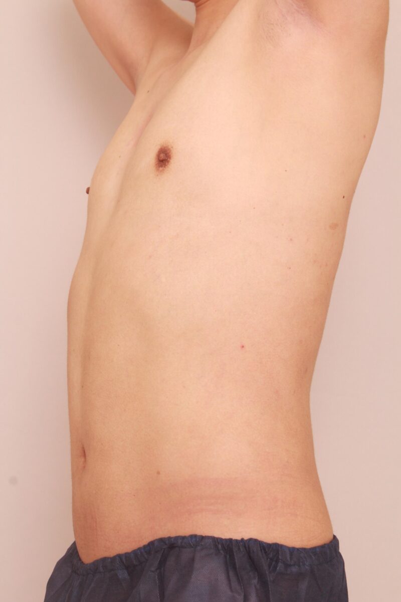 お腹・腰の脂肪吸引　術後6ヵ月の経過（男性編）