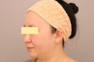 ４６歳女性　頬・顎下ベイザー脂肪吸引の術前