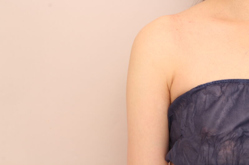 二の腕・肩の脂肪吸引 術後6ヵ月の経過