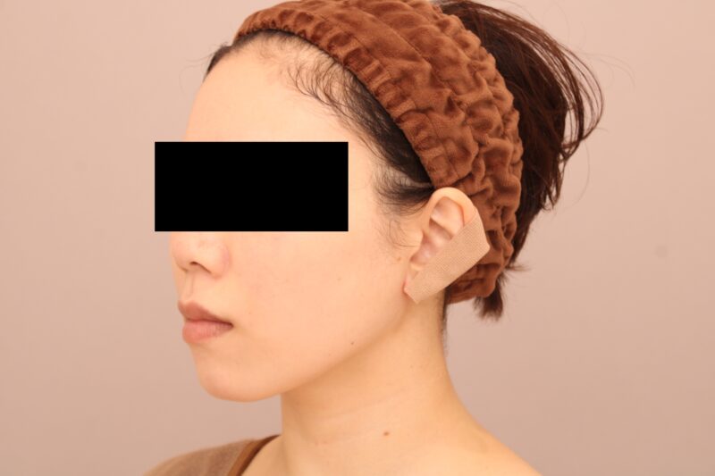 お顔の脂肪吸引 術後6ヵ月の経過