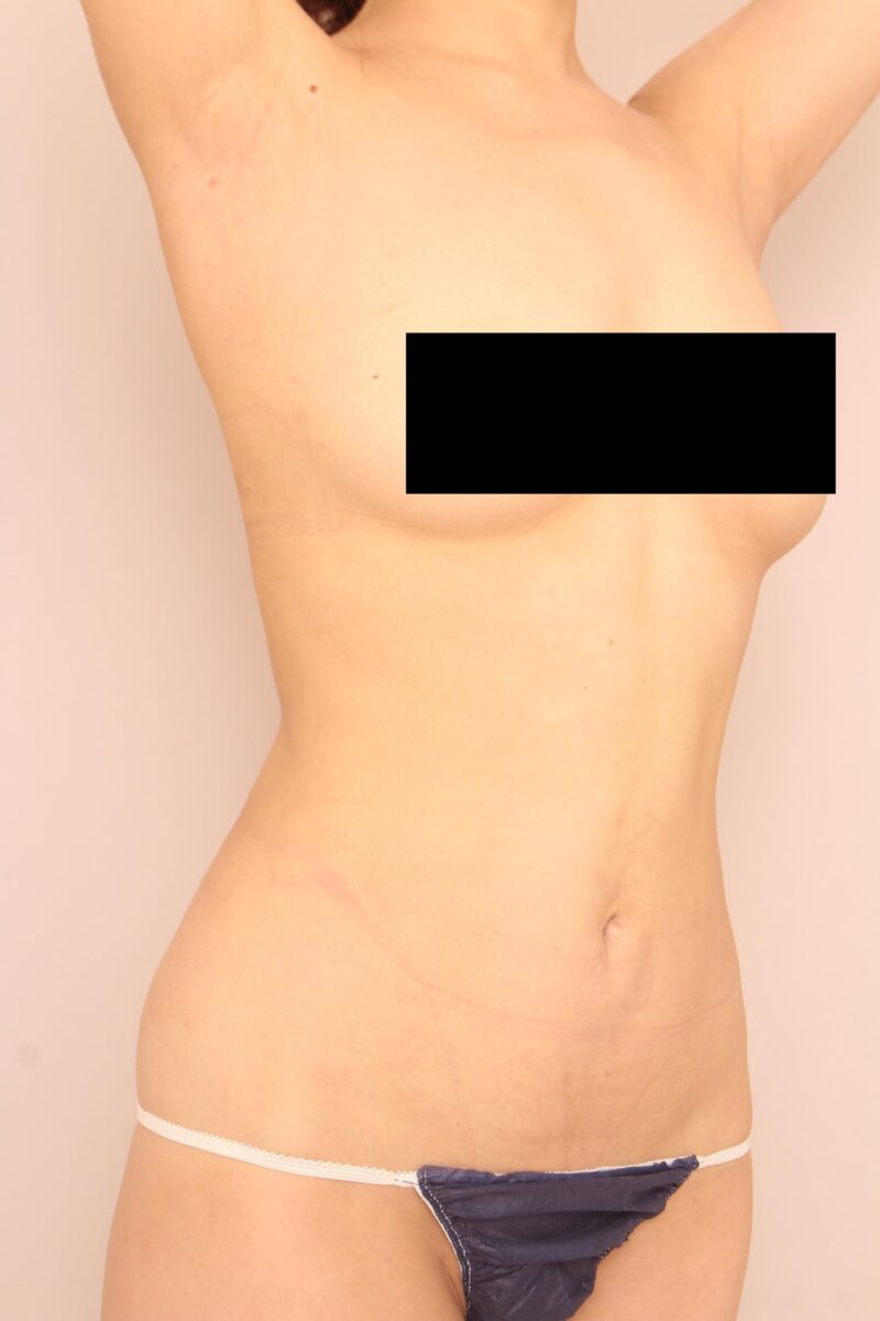 お腹・腰の脂肪吸引 術後3カ月の経過