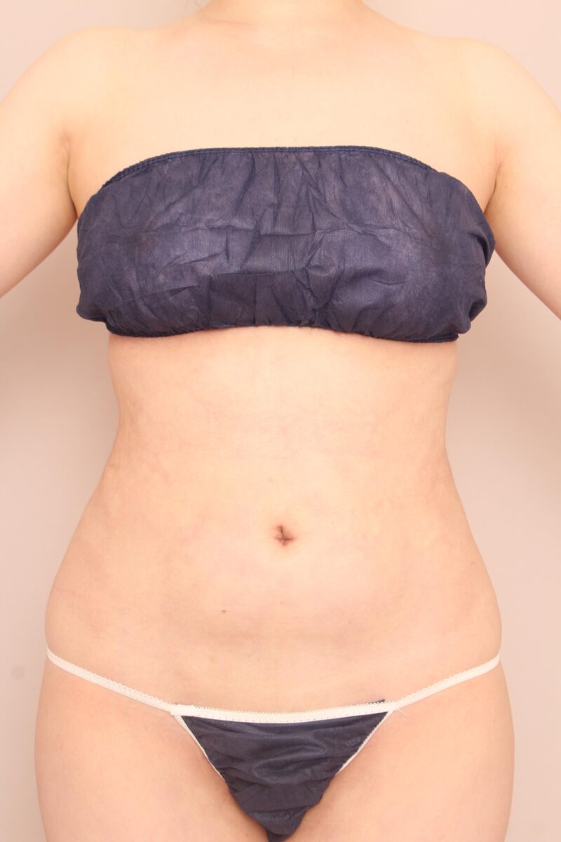 お腹全体胸下腰の脂肪吸引3か月後♡