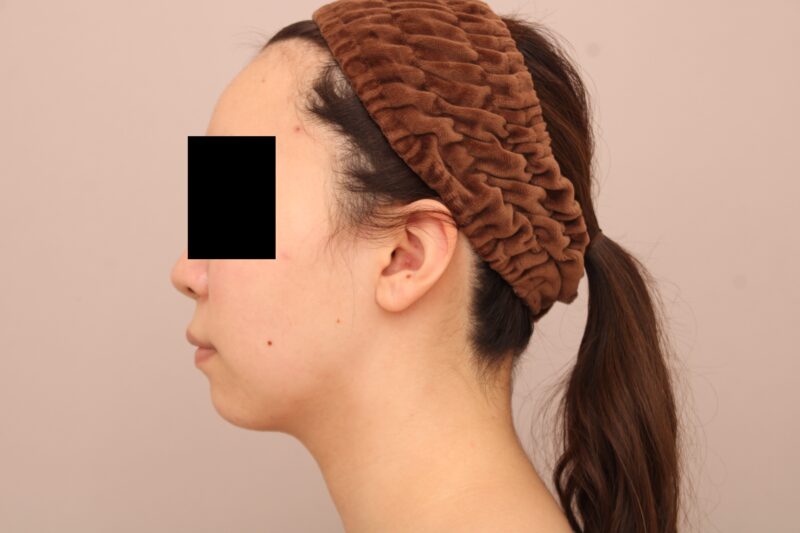 お顔の脂肪吸引 術後3カ月の経過