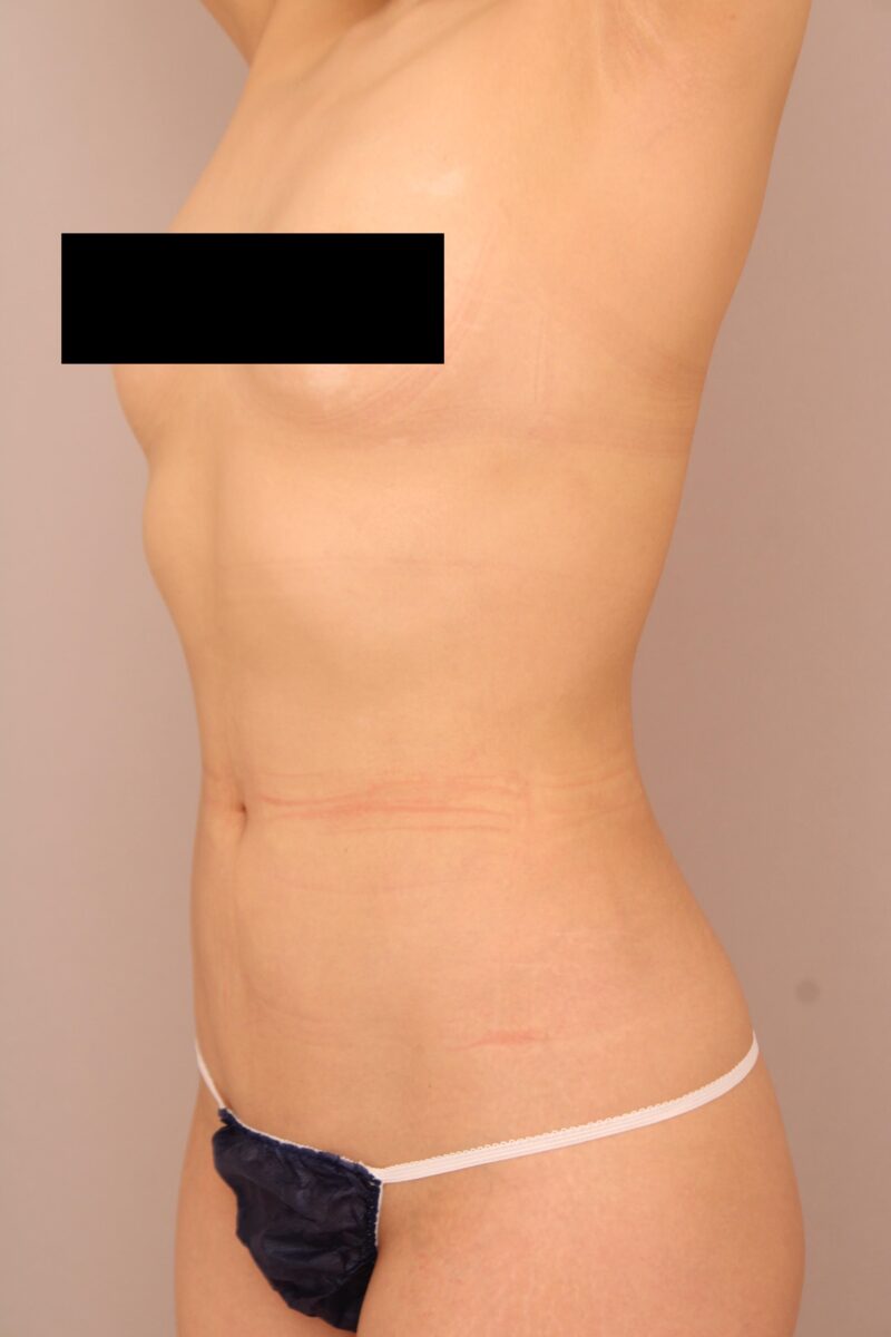 お腹・腰の脂肪吸引 術後3カ月の経過