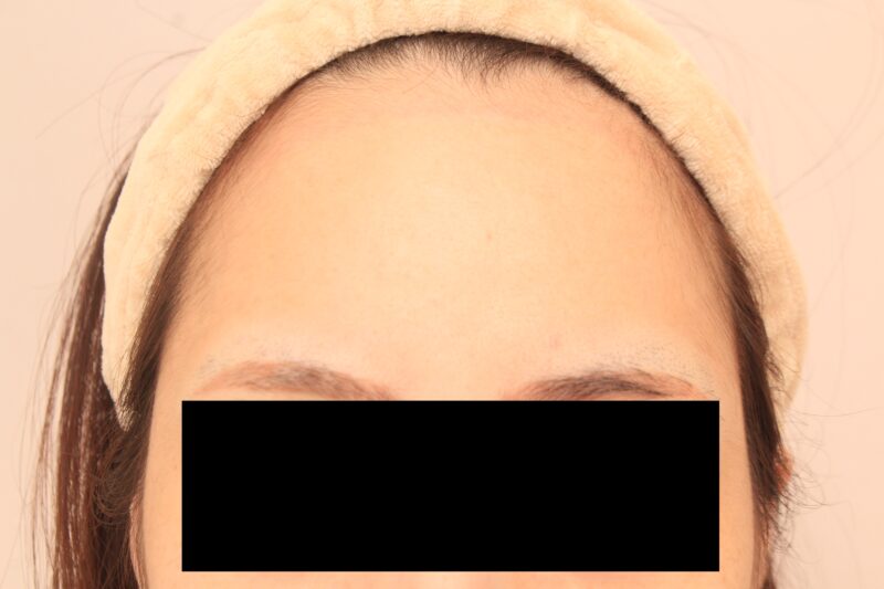 20代のやせ型の方のこめかみ脂肪注入♪