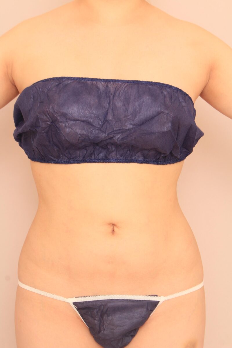 みんなで目指そう峰不二子♡お腹全体胸下腰の脂肪吸引半年後♪