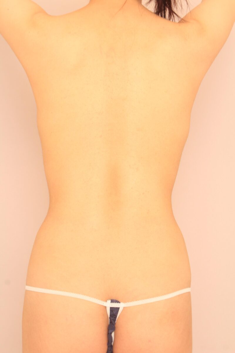 お腹全体胸下腰の脂肪吸引1か月後