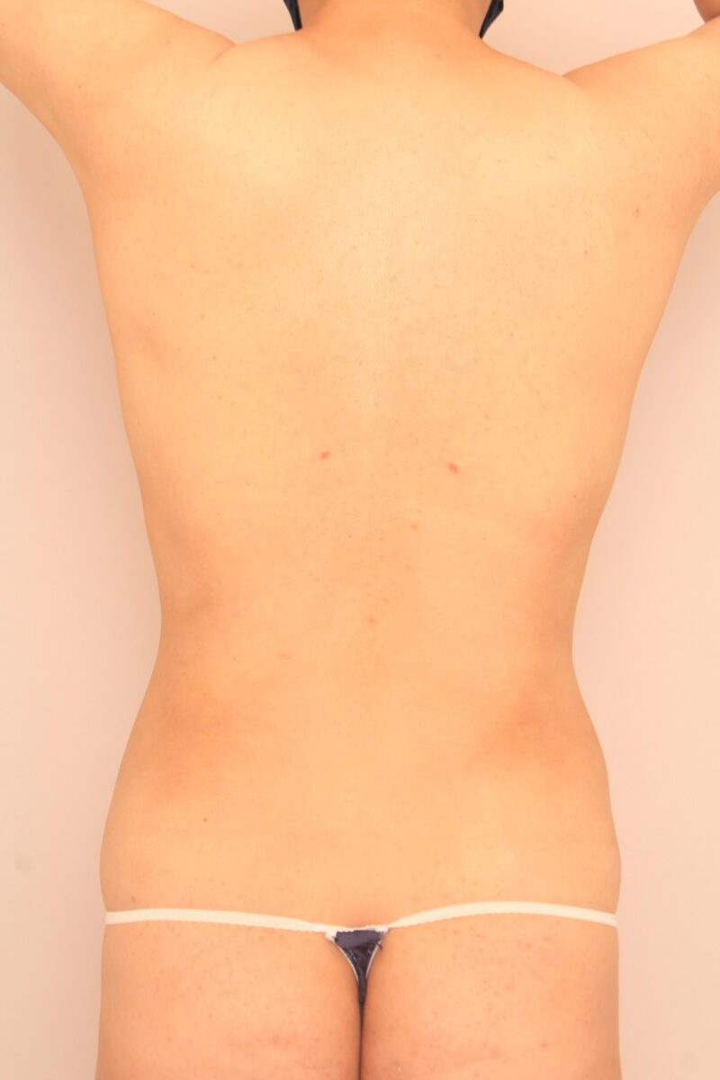 背中全体の脂肪吸引半後
