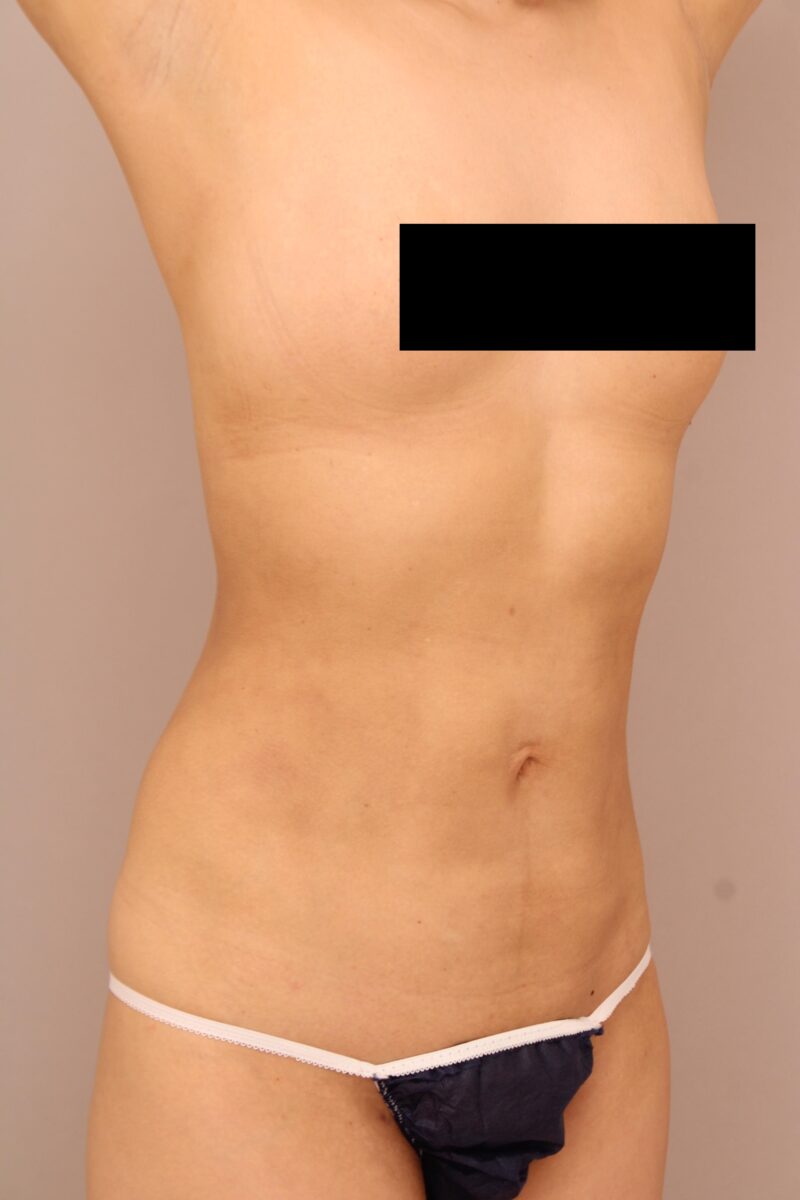 お腹・腰の脂肪吸引 術後3ヵ月の経過