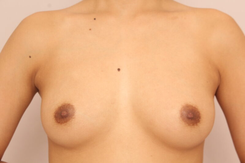 コンデンスリッチ豊胸 術後1ヵ月の経過