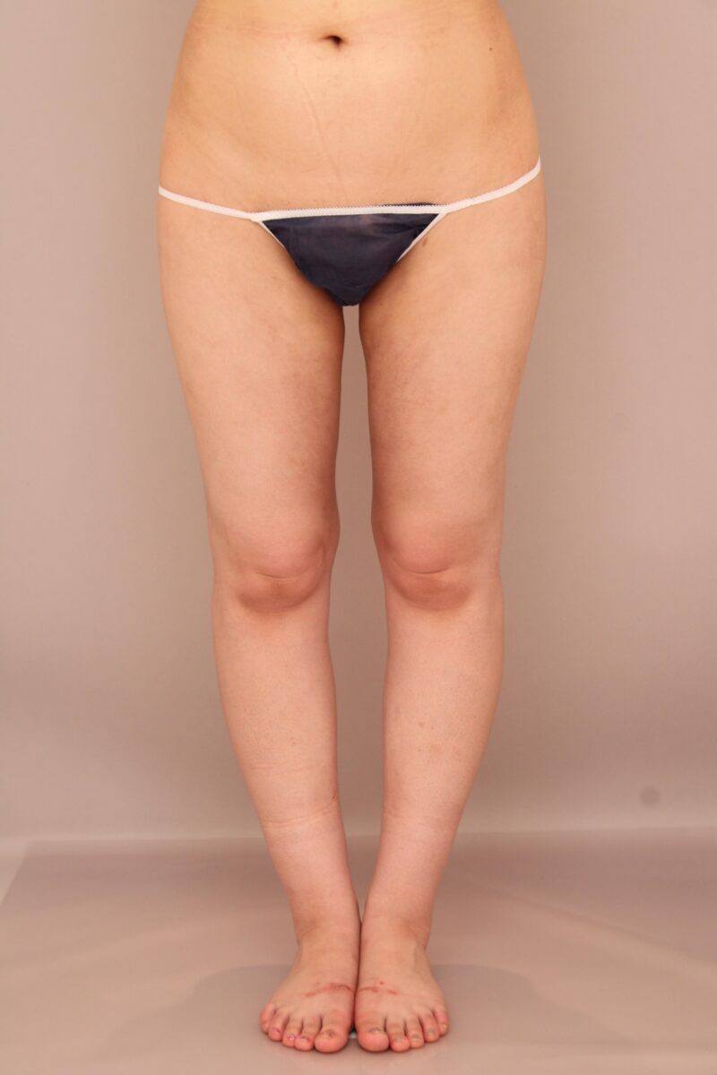 太ももの脂肪吸引 術後1ヵ月の経過