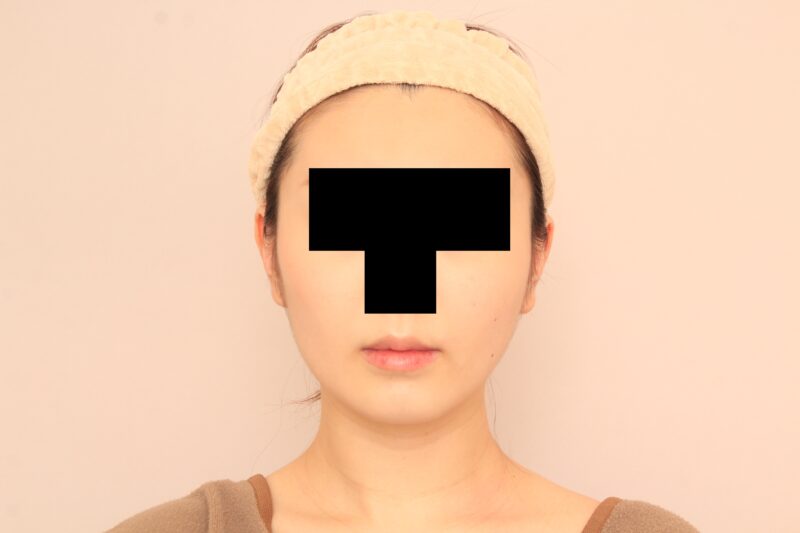 20代ほほ顎脂肪吸引のモニター様3か月後
