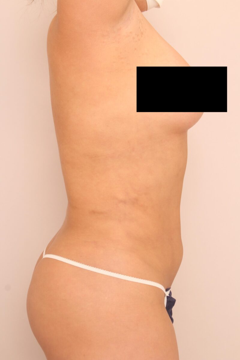 お腹全体、胸下、腰の脂肪吸引1か月後