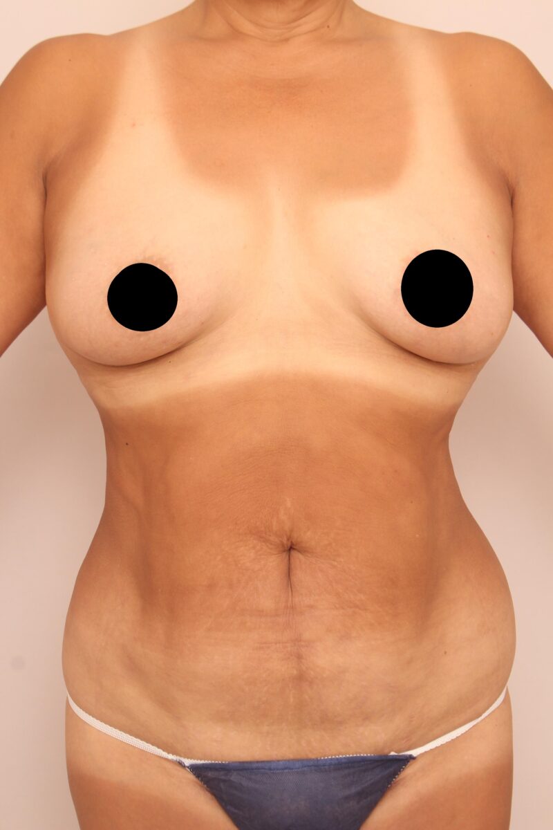 50代の大量吸引のモニター様3か月後