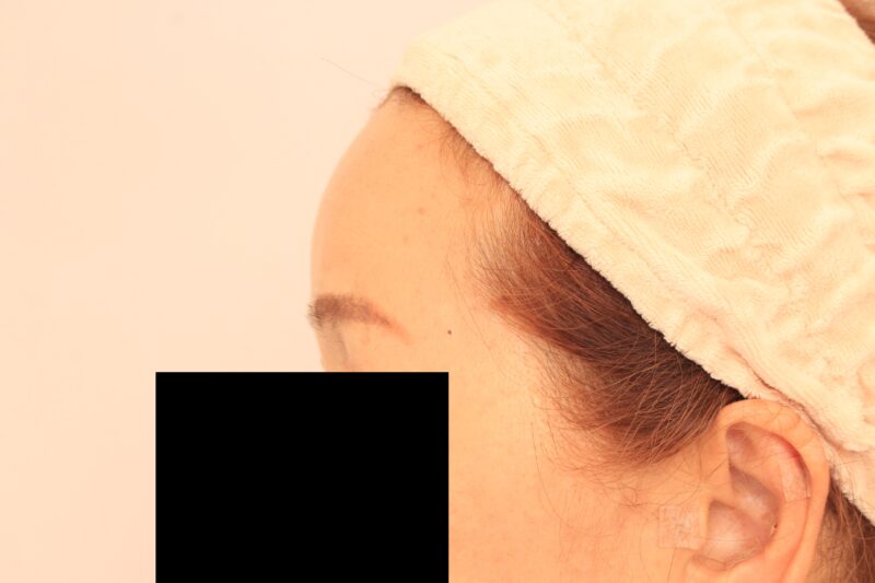 オデコこめかみの脂肪注入4か月後