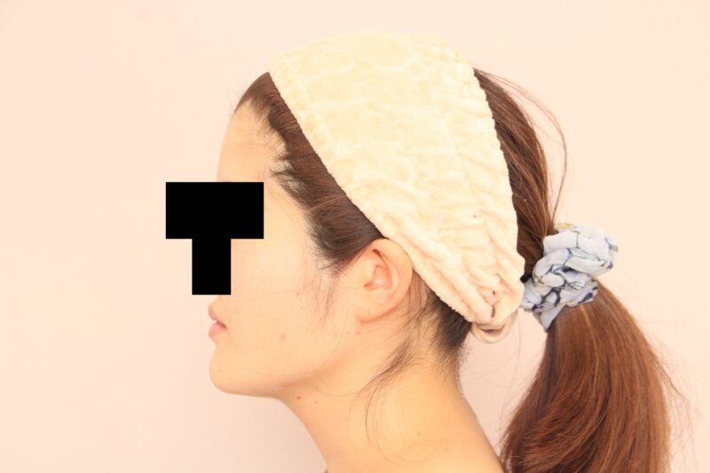 ほほ顎脂肪吸引でフェイスラインをシュッとさせましょう!3か月後