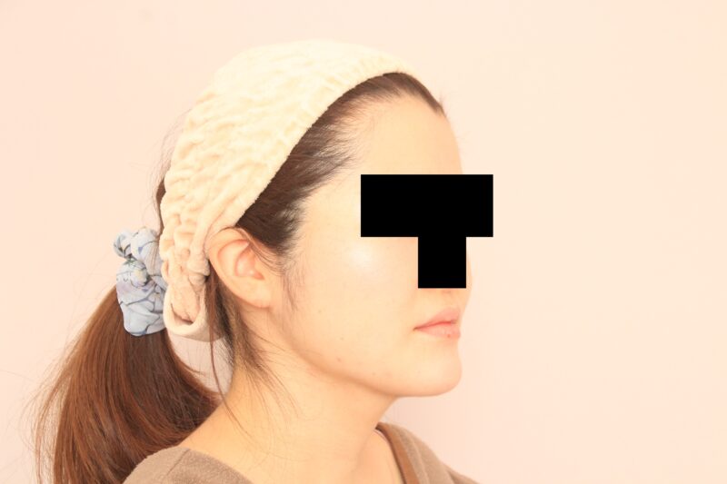 ほほ顎脂肪吸引の3か月後!フェイスラインを劇的変化させましょう!